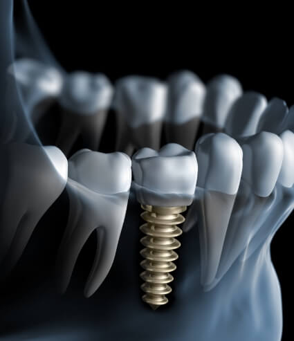 Animated x ray of a person with a dental implant in Melbourne
