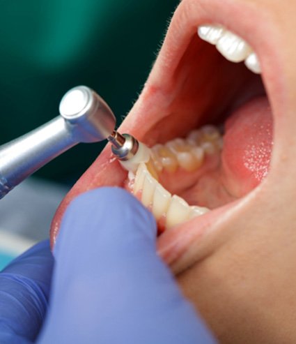 a dental hygienist polishing a patient’s teeth
