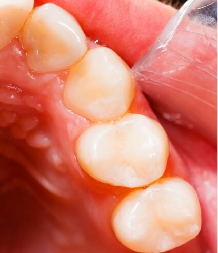 Close up of a row of teeth with dental sealants