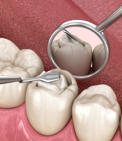 Animated tooth having a tooth colored filling placed