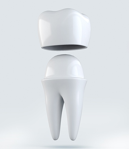 Illustration of a tooth and dental crown in Melbourne, FL