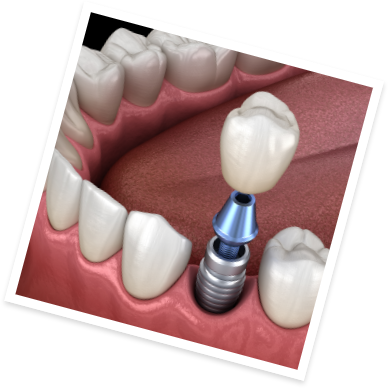 Animated dental implant with dental crown