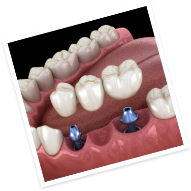 Two animated dental implants with dental bridge