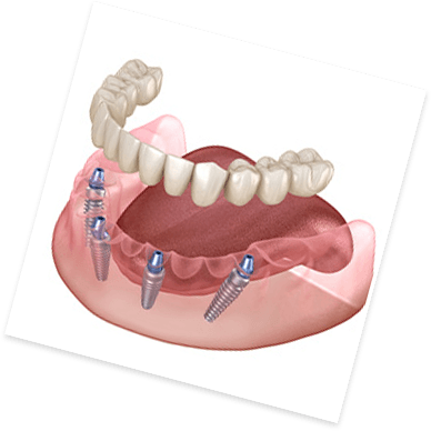 Animated dental implant with dental crown