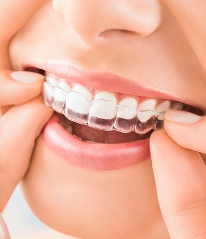 Closeup of woman pulling Invisalign off upper arch