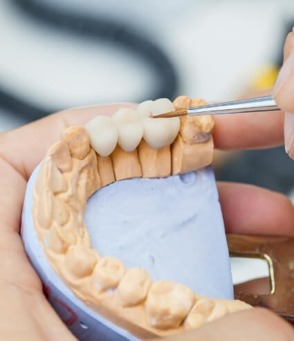 Dentist creating a dental bridge to replace missing teeth in Melbourne