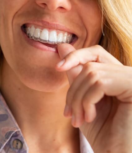 Blonde woman putting Invisalign clear aligner in her mouth