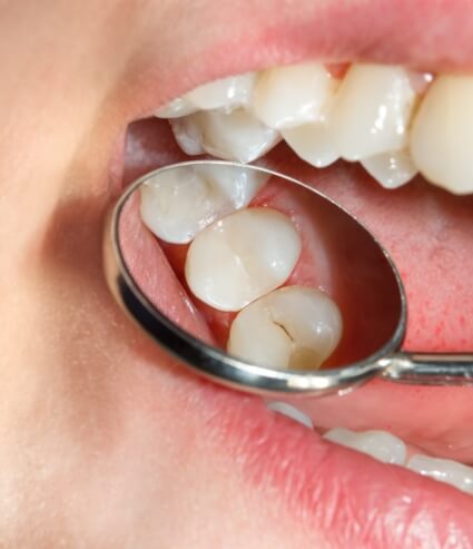 Dental mirror showing a tooth with tooth colored fillings in Melbourne