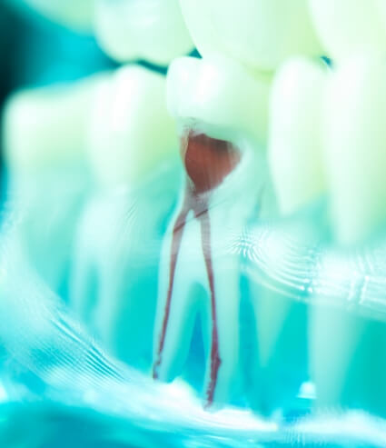 Model of tooth showing root canals inside of it