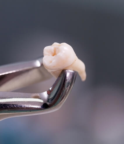 Extracted tooth held in pair of dental forceps