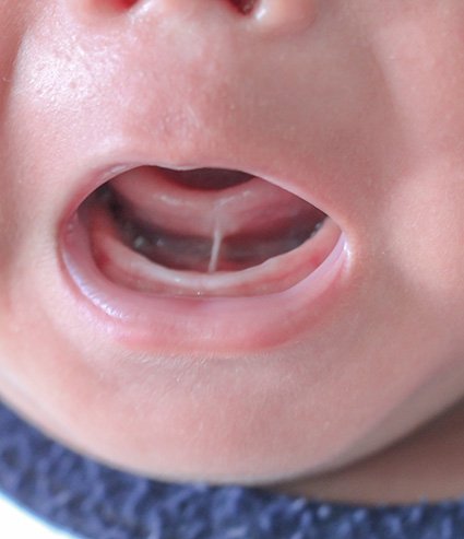 Tongue ties are caused by a thick, short, or malformed lingual frenulum