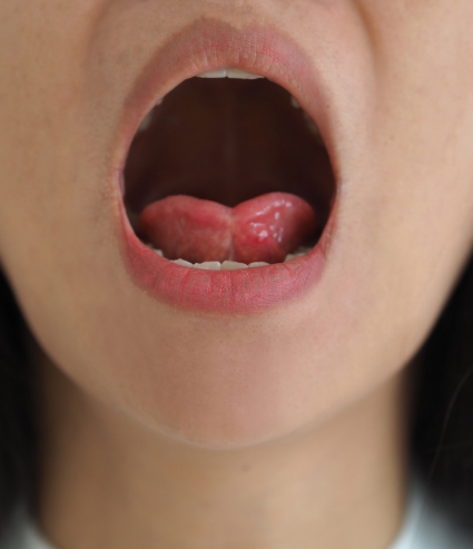 Tongue ties are caused by a thick, short, or malformed lingual frenulum