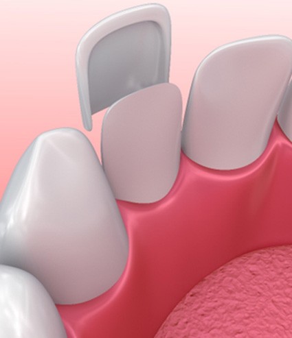 Illustration of veneer being placed on tooth