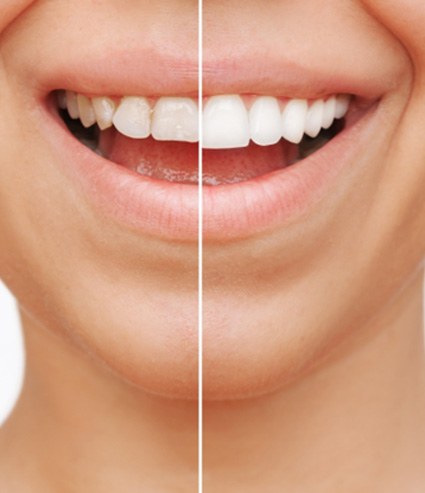 Closeup of patient's smile before and after teeth whitening