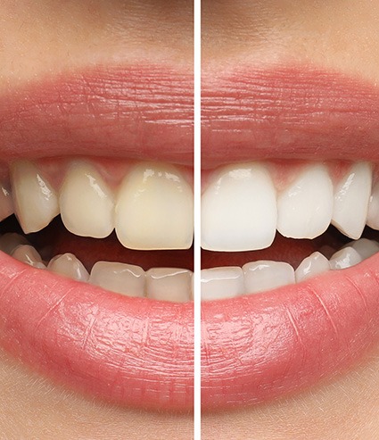 Patient's smile before and after teeth whitening treatment