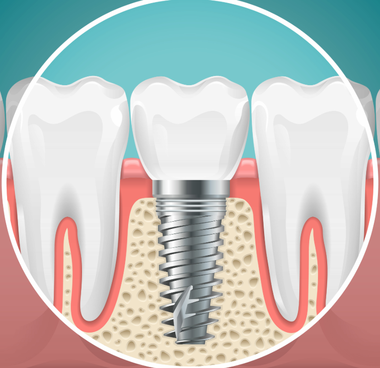 Illustrated cross section of a dental implant